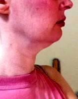 People Who Wish To Reduce A Double Chin Can Do So Thanks To The Device's Special CoolMini Applicator