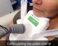 CoolSculpting Mini For Your Double Chin