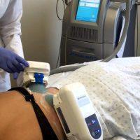 With Each Coolsculpting Treatment Cycle We Expect 20% Of The Fat Cells To Die