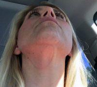 Best Non Invasive Fat Removal On Chin