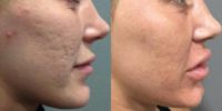 25-34 year old woman treated with Microneedling