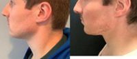 Man treated with Kybella