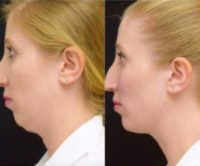 35-44 year old woman treated with KYBELLA & Voluma