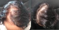55-64 year old woman treated with Hair Loss Treatment