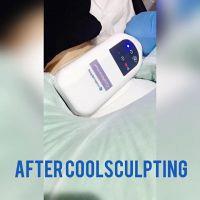 After Coolsculpting