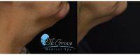 52 Year Old Woman Treated With CoolSculpting Under Chin With Doctor Mahmoud Khattab, MD, Elk Grove Physician 166