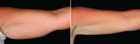 55 Year Old Woman Treated With Arm CoolSculpting