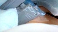 Are There Side Effects From Coolsculpting
