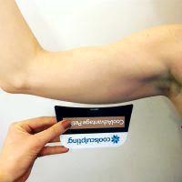 Cool Sculpting Fat In Arms