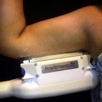 CoolSculpting Arms Patient Is Someone Who Has Fat They Want To Lose In A Particular Area