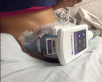 CoolSculpting Is A Cryolipolysis Treatment For The Removal Of Fat Cells
