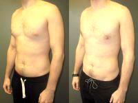 CoolSculptinga Reduces Fat And Can Be Used To Treat Pseudogynecomastia