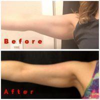 Coolsculpting Arms Before After 12 Weeks