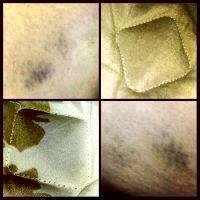 Coolsculpting Outer Thighs Bruises