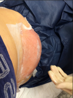 Coolsculpting Recovery Instructions