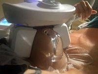 Doctor Donna Tran, Houston Plastic Surgeon Cold Freeze Fat Loss Photo