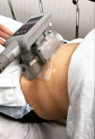 IS ABDOMINAL SWELLING AND PAIN NORMAL AFTER COOLSCULPTING