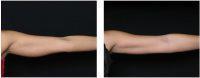 Upper Arms Before And After