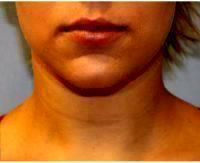 24 Year Old Woman Treated With CoolSculpting Of Chin By Dr Benjamin Wood, MD, FACS, Raleigh-Durham Plastic Surgeon