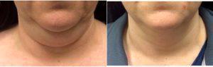 35 Year Old Woman Treated With CoolSculpting For Chin Area With Dr. Ramandeep Sidhu, MD, Issaquah Vascular Surgeon