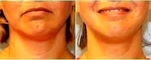 35 Year Old Woman Treated With Coolsculpting Neck Chin By Doctor Jeremy Pyle, MD, Raleigh-Durham Plastic Surgeon