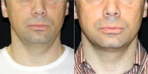 36 Year Old Man Treated With Coolsculpting Double Chin With Dr Scott Gerrish, DO, Vienna Physician