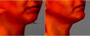 36 Year Old Woman Treated With CoolSculpting For Chin Fat By Dr. Jeremy Pyle, MD, Raleigh-Durham Plastic Surgeon