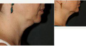 37 Year Old Man Treated With CoolSculpting For Chin Fat By Doctor Hardik Soni, MD, Summit Emergency Medicine Physician