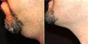 39 Year Old Man Treated With CoolSculpting With Dr Parham Gharagozlou, MD, FACP, Walnut Creek Physician