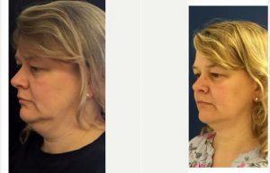 44 Year Old Lady Treated With Cool Sculpting To The Neck Area. By Dr Tariq Ahmad, MBBChir, FRCS(Plast), Cambridge Plastic Surgeon