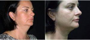 44 Year Old Woman Treated With CoolSculpting For Chin Area By Doctor Mark Edinburg, MBBCH, FRACS, Sydney Plastic Surgeon