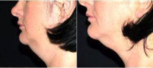 44 Year Old Woman Treated With CoolSculpting For Chin Area With Dr. Mark Edinburg, MBBCH, FRACS, Sydney Plastic Surgeon
