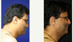 45 Year Old Man Treated With Coolsculpting The Submandibular Region Using The Coolmini Applicator With Dr Kris M. Reddy, MD, FACS, West Palm Beach Plastic Surgeon