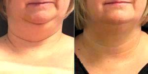 45 Year Old Woman Treated With Coolsculpting Double Chin