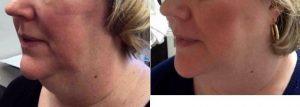 46 Year Old Woman Treated With Coolsculpting Double Chin By Dr Melda A. Isaac, MD, Washington DC Dermatologic Surgeon