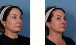 52 Year Old Woman Treated With CoolSculpting With Doctor Margaret Weiss, MD, Baltimore Dermatologic Surgeon