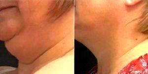 52 Year Old Woman Treated With Coolsculpting Under Chin