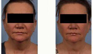 53 Year Old Woman Treated With CoolSculpting By Dr Ran Y. Rubinstein, MD, Manhattan Facial Plastic Surgeon