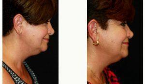 54 Year Old Woman Treated With CoolSculpting Of The Submental Area ('Double Chin') With Doctor Kris M. Reddy, MD, FACS, West Palm Beach Plastic Surgeon