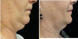 54 Year Old Woman Treated With Coolsculpting Under Chin