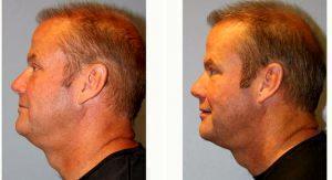 55 Year Old Man Treated With CoolSculpting With Dr Benjamin Wood, MD, FACS, Raleigh-Durham Plastic Surgeon