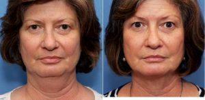 56 Year Old Woman Treated With Coolsculpting Double Chin With Doctor Guy Cappuccino, MD, Mount Airy Plastic Surgeon