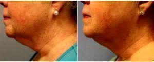 56 Year Old Woman Treated With Coolsculpting Neck Chin With Dr. Jeremy Pyle, MD, Raleigh-Durham Plastic Surgeon