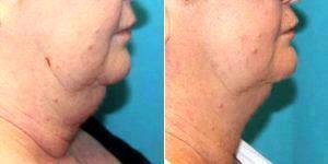 58 Year Old Woman Treated With CoolSculpting For Chin Fat With Dr. David Janssen, MD, FACS, Oshkosh Plastic Surgeon