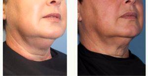 58 Year Old Woman Treated With Coolsculpting Double Chin With Dr Margaret Weiss, MD, Baltimore Dermatologic Surgeon