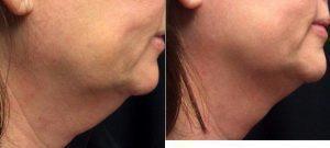 59 Year Old Woman Treated With CoolSculpting For Chin Fat With Doctor Ramandeep Sidhu, MD, Issaquah Vascular Surgeon