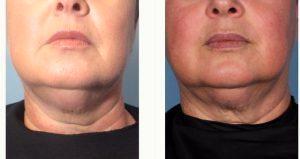 62 Year Old Woman Treated With CoolSculpting By Doctor Margaret Weiss, MD, Baltimore Dermatologic Surgeon