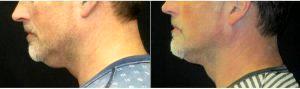 64 Year Old Man Treated With Coolsculpting Double Chin