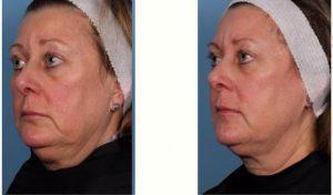 64 Year Old Woman Treated With CoolSculpting For Chin Area By Doctor Margaret Weiss, MD, Baltimore Dermatologic Surgeon