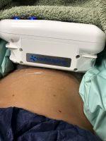 A Noninvasive Fat Removal Procedure That Freezes Fat Cells And Causes Them To Die